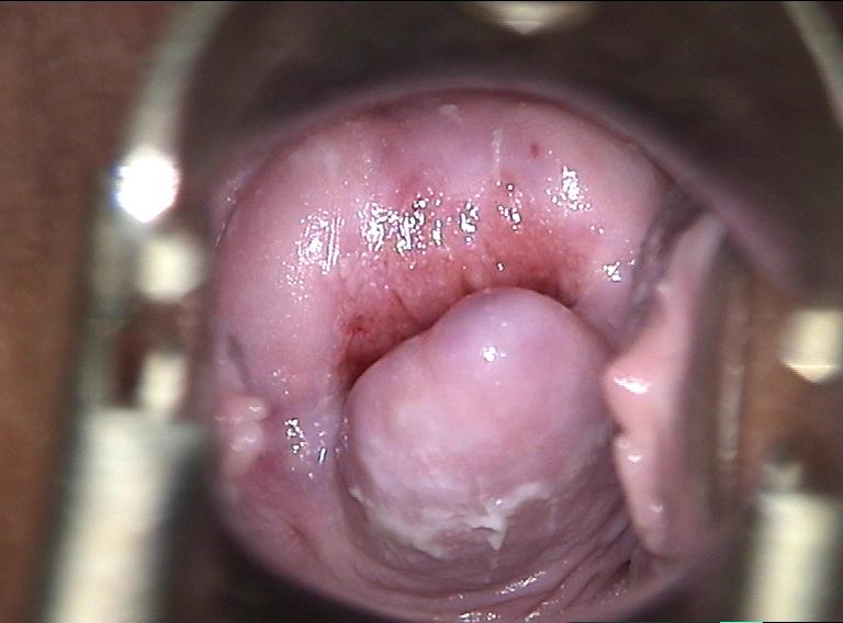 colposcopy - 1 - normal cervix with squamocolumnar junction