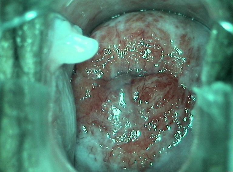 colposcopy - 10 - abnormal vascular patterns seen in cervical neoplasia