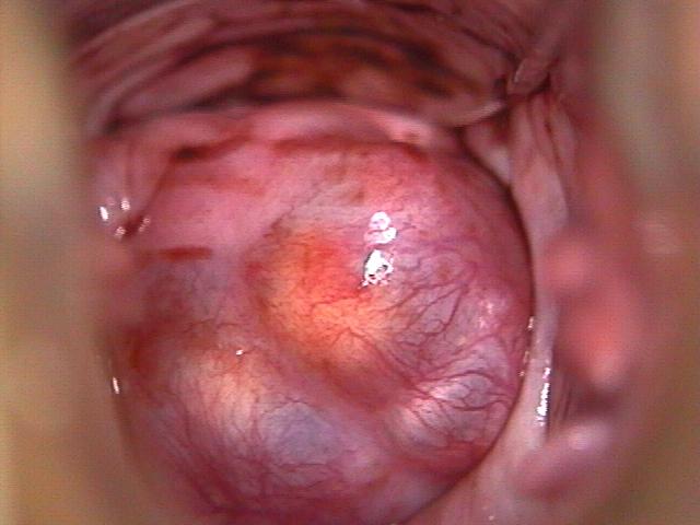colposcopy - 12 - Nabothian cysts
