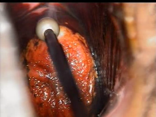 colposcopy - 13 - ball electrode cauterization of cervical neoplasia.bmp