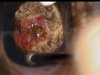 colposcopy - 14 - cervix following cauterization of cervical neoplasia.bmp