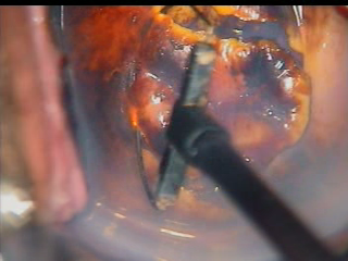 colposcopy - 15 - large loop excision of cervical neoplasia LEEP.bmp