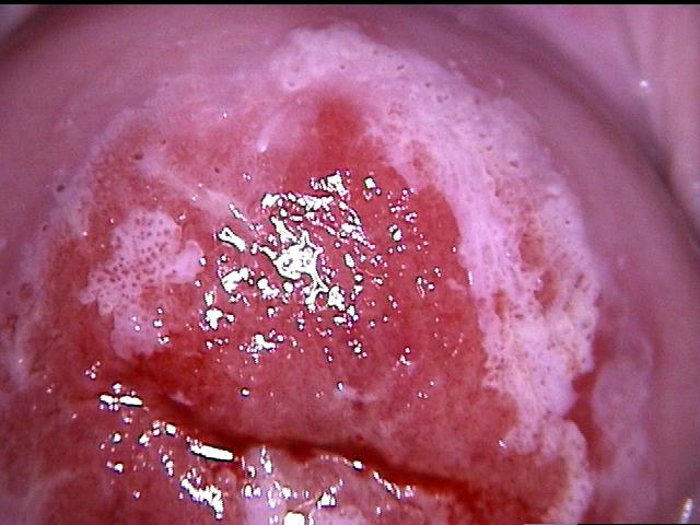 colposcopy - 2 - acetowhite areas