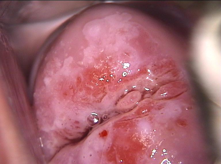 colposcopy - 4 - vascular pattern on the transformation zone