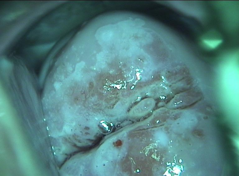 colposcopy - 5 - examination of the vascular pattern with green filter