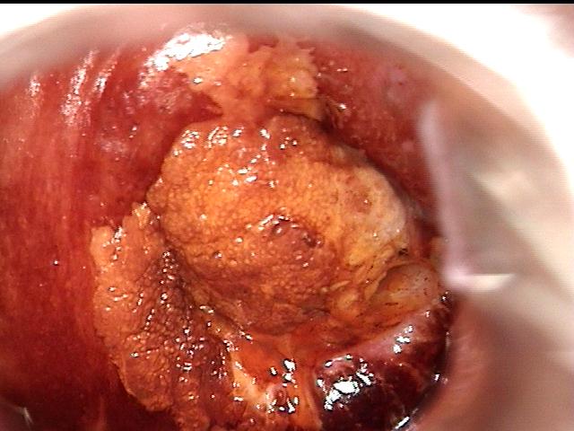 colposcopy - 6 - large acetowhite area suspicious of extensive neoplasia