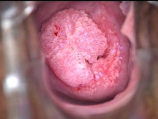 colposcopy - 7 - HPV induced papillomatous growth