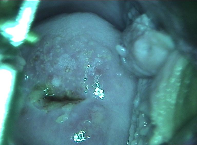 colposcopy - 8 - mosaic pattern seen in CIN