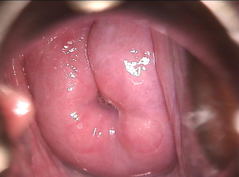 colposcopy - 9 - menopausal cervix with transformation zone regressing into cervical canal
