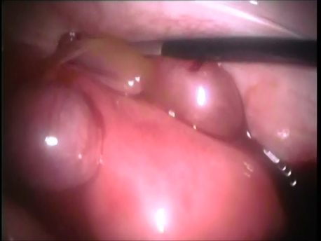 ectopic pregnancy - 1 - huge ruptured ectopic pregnancy with a formed fetus inside