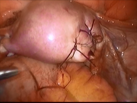ectopic pregnancy - 10 - suturing of the uterine wall