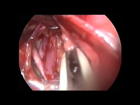 ectopic pregnancy - 12 - cauterization of the main blood supply to the pelvis