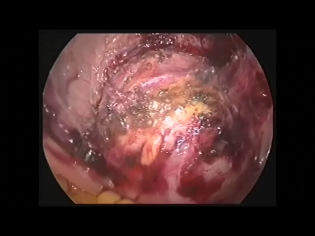 ectopic pregnancy - 13 - the scar ectopic pregnancy