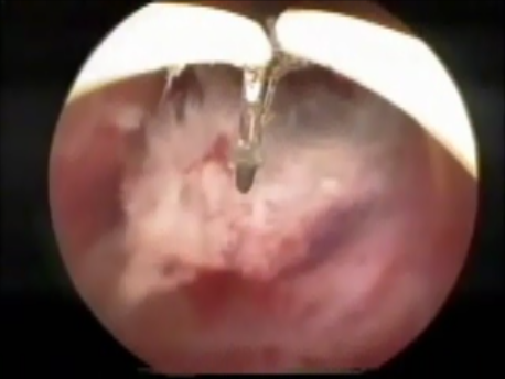 ectopic pregnancy - 16 - cervical ectopic pregnancy