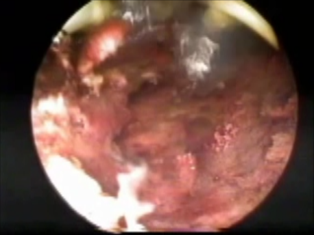 ectopic pregnancy - 17 - resection of cervical ectopic pregnancy