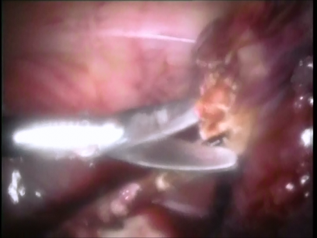 ectopic pregnancy - 2 - removal of the Fallopian tube in a ruptured ectopic pregnancy