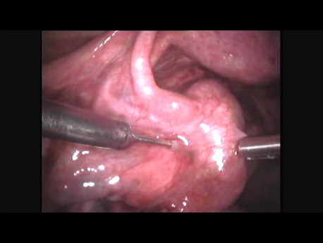 ectopic pregnancy - 3 - unruptured ectopic pregnancy