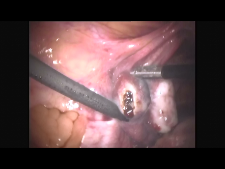 ectopic pregnancy - 4 - incision of the Fallopian tube