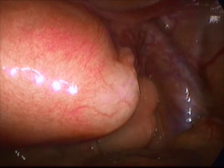 ectopic pregnancy - 7 - cornual ectopic pregnancy