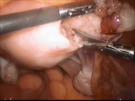 ectopic pregnancy - 9 - incision of the uterine wall to remove the ectopic pregnancy