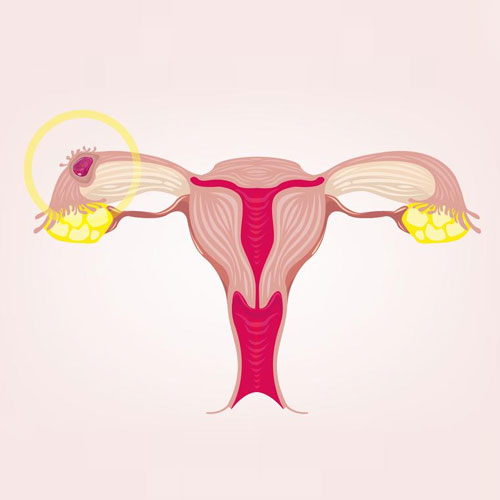 Ectopic Pregnancy