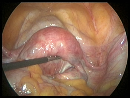 endometriosis - gallery - 1 extensive endometriois with frozen pelvis