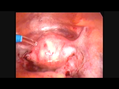 endometriosis - gallery - 10 final picture after removal of endometrioma