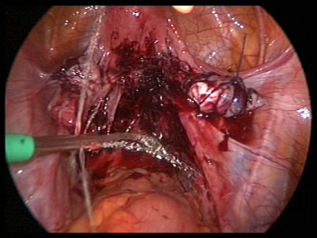 endometriosis - gallery - 11 suspension of ovaries to reduce adhesions