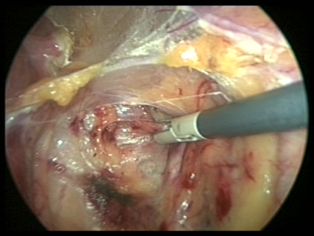 endometriosis - gallery - 3 cauterizing the uterine arteries