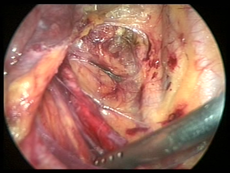 endometriosis - gallery - 4 separating the ureter from adhesions