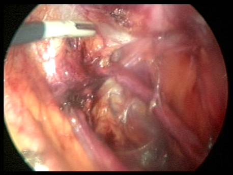 endometriosis - gallery - 5 separating the ureter adherent to the ovarian mass