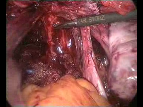 endometriosis - gallery - 6 separating the rectum completely from the uterus and vagina