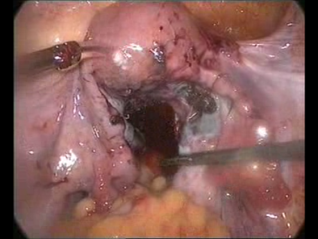 endometriosis - gallery - 7 final picture after extensive endometriosis surgery