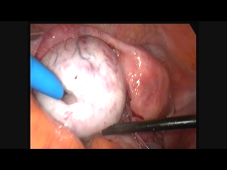 endometriosis - gallery - 8 huge ovarian endometrioma