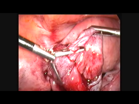 endometriosis - gallery - 9 removal of endometrioma