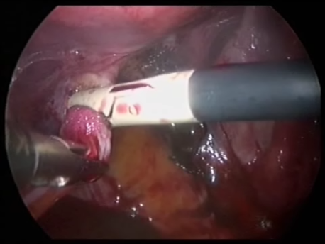 endometriosis - gallery - LUNA cauterizing the uterosacral ligaments