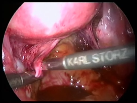 endometriosis - gallery - LUNA dissecting the uterosacral ligaments