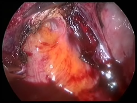endometriosis - gallery - LUNA dividing the uterosacral ligaments