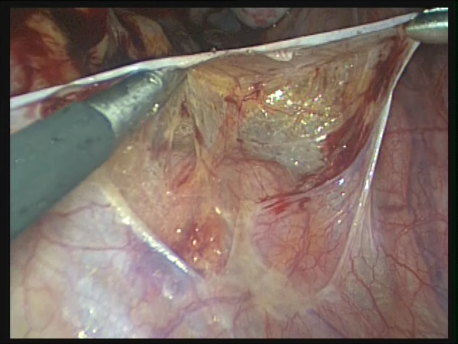 endometriosis - gallery - Presacral neurectomy dissecting the presacral space
