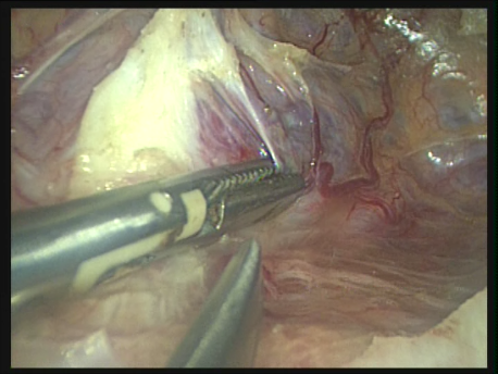 endometriosis - gallery - Presacral neurectomy the presacral nerves divided