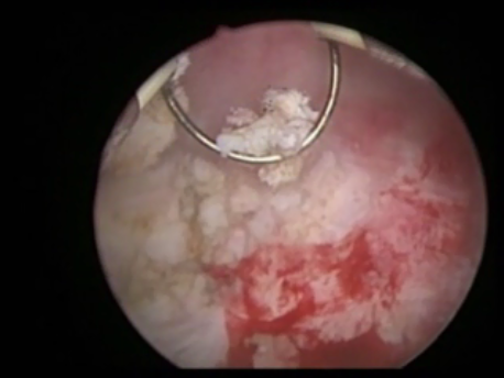 fibroids - hysteroscopic myomectomy - uterine cavity after removal of fibroid
