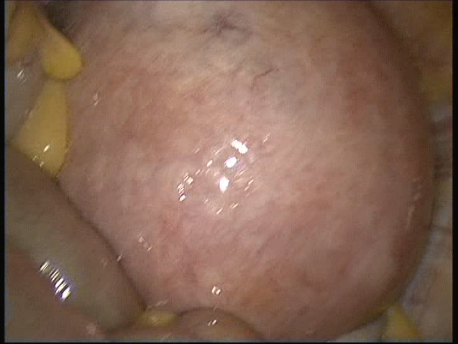 fibroids - laparoscopic myomectomy - 1 large uterus with multiple fibroids