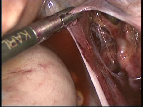 fibroids - laparoscopic myomectomy - 2 uterine artery and vein