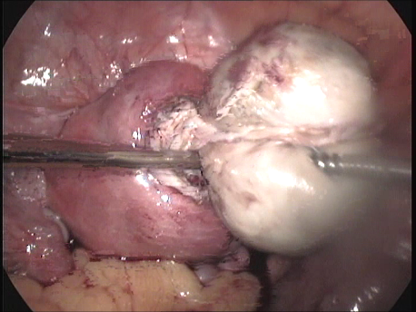 fibroids - laparoscopic myomectomy - 27 removal of fibroid