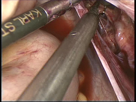 fibroids - laparoscopic myomectomy - 3 clipping of the uterine vessels