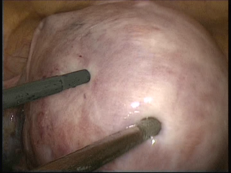 fibroids - laparoscopic myomectomy - 4 infiltration of the utrus and fibroid with saline