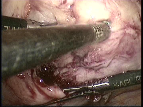 fibroids - laparoscopic myomectomy - 5 removal of the fibroids