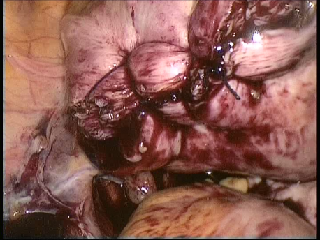 fibroids - laparoscopic myomectomy - 6 suturing of the fibroid bed