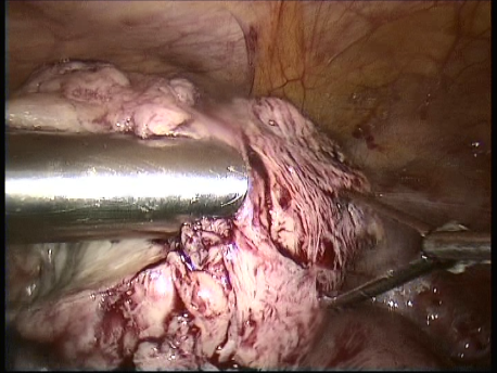 fibroids - laparoscopic myomectomy - 7 morcellation of the multiple fibroids