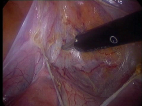 gynecological cancer surgery - 1 dissecting the bladder in a radical hysterectomy